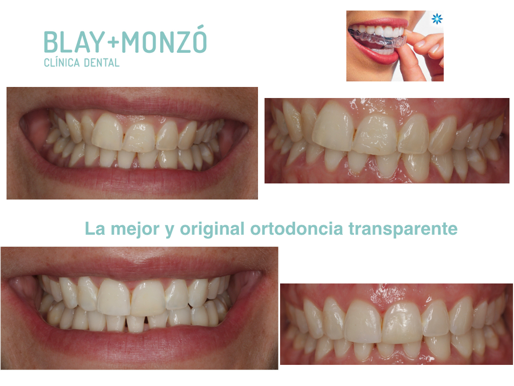 Caso: Invisalign - Clínica Dental Blay Monzo