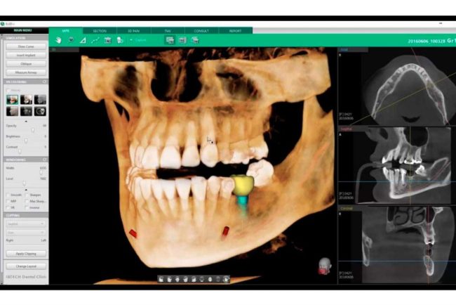 Implantología en clínica Blay+Monzó