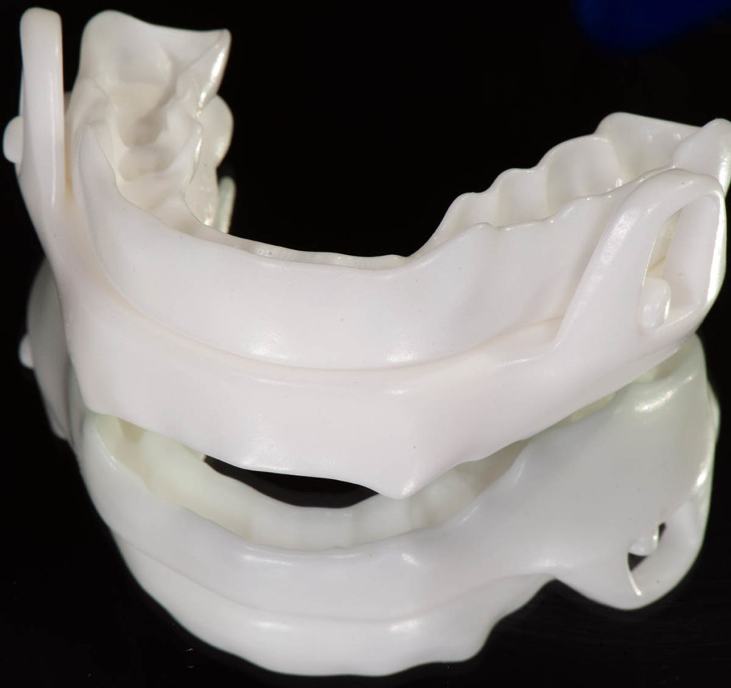 Dispositivo de Avance Mandibular | Clínica Dental Blay Monzo