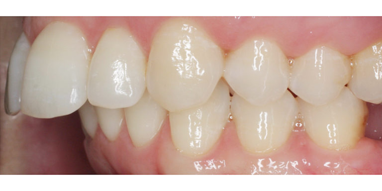 maloclusión. Resalte dental