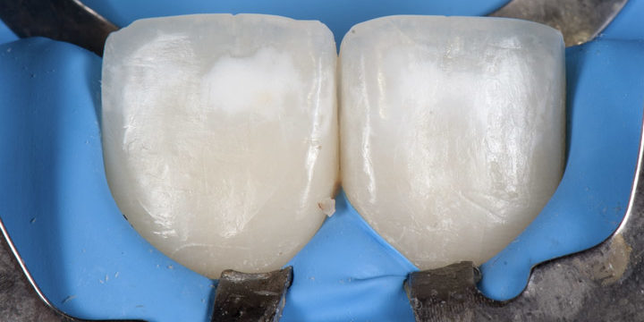 Manchas blancas en los dientes