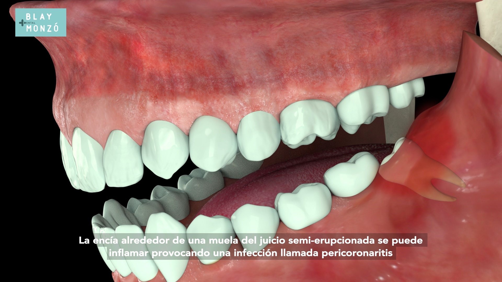 Muelas De Juicio Todo Lo Que Tienes Que Saber Clínica Dental Blay Monzo 6747