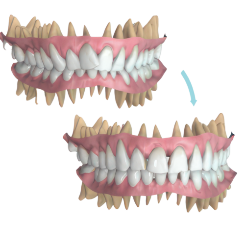 dientes-ortodoncia-castellon