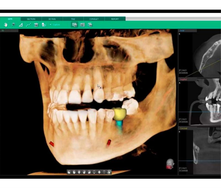 Implantes dentales de alta gama