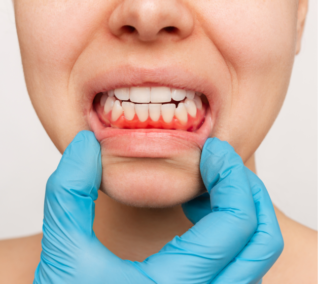 La periodontitis es una enfermedad crónica que afecta a gran parte de la población