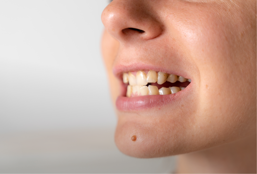 Manchas en los dientes post