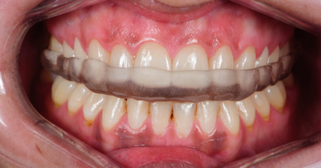 QUÉ ES LA FÉRULA DE DESCARGA