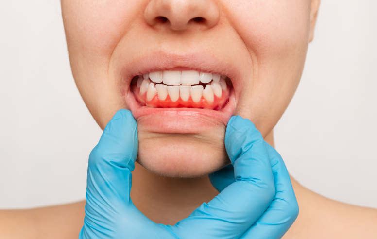 Sangrado en las encías