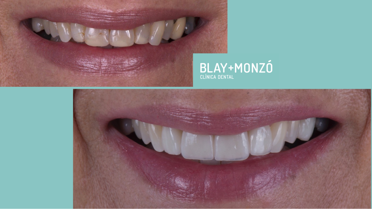 Ventajas de las carillas dentales