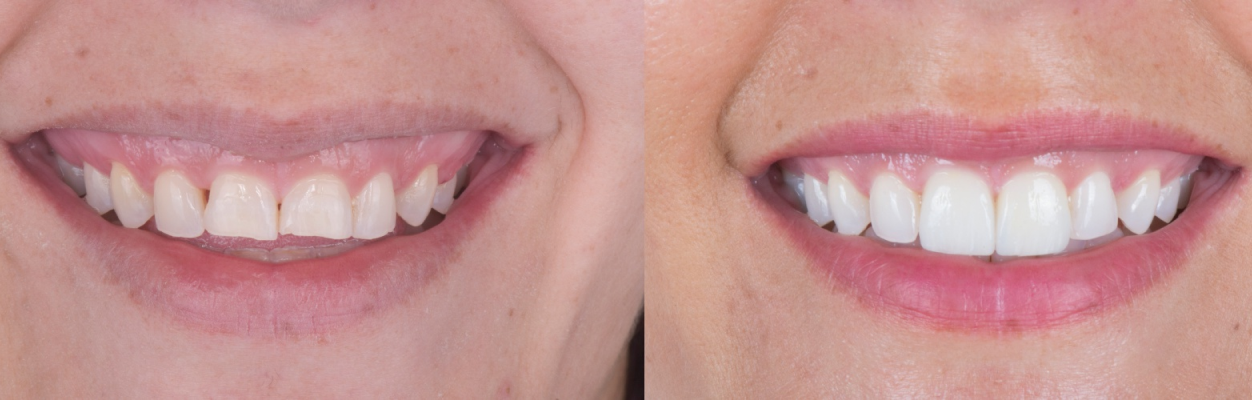 el color para tus dientes