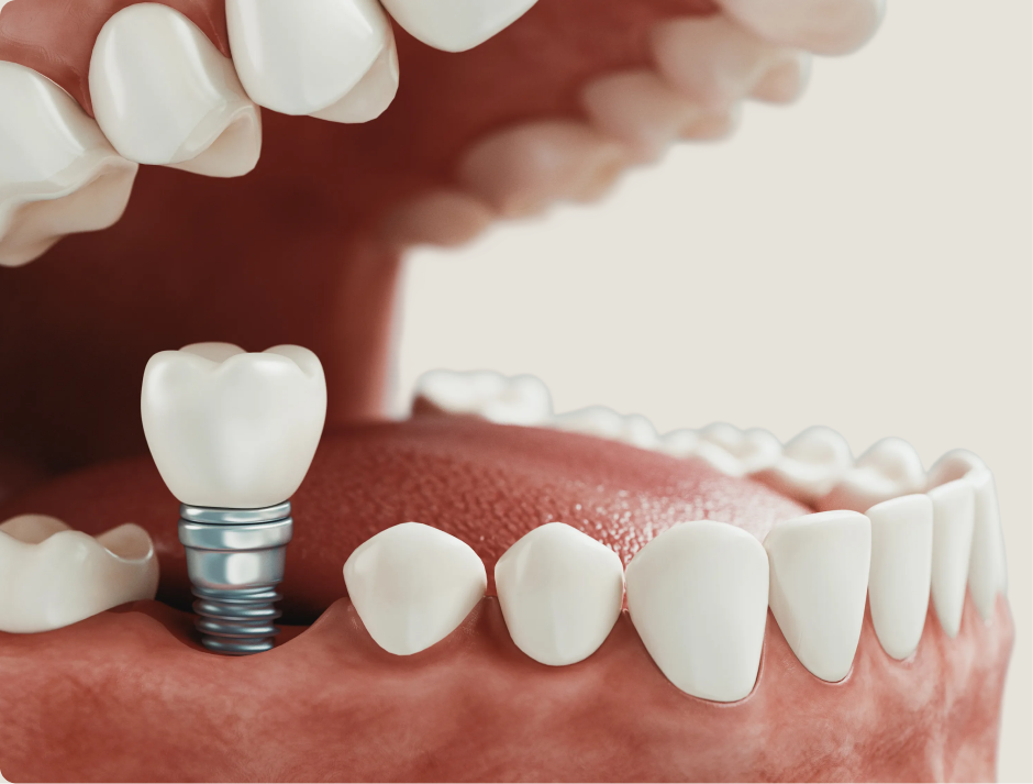 ¿Que son los implantes dentales